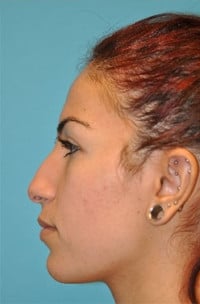 Rhinoplasty (Nose Job) Before and After Photos