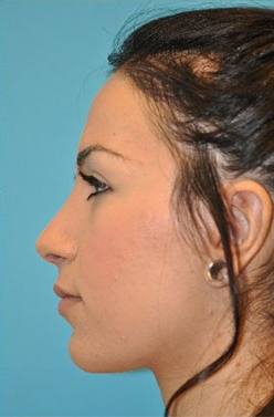 Rhinoplasty (Nose Job) Before and After Photos Case 4333 After Photo Rhinoplasty (Nose Job) Before and After Photos