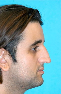 Rhinoplasty (Nose Job) Before and After Photos Case 4339 Before Photo Rhinoplasty (Nose Job) Before and After Photos