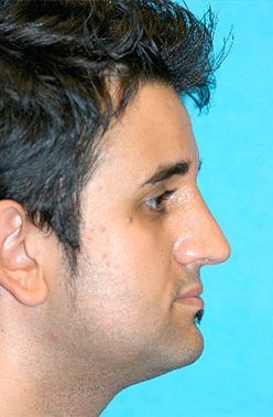 Rhinoplasty (Nose Job) Before and After Photos Case 4339 After Photo Rhinoplasty (Nose Job) Before and After Photos