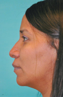 Rhinoplasty (Nose Job) Case 4351 Before Photo Rhinoplasty (Nose Job)
