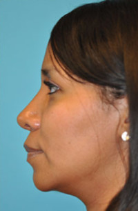 Rhinoplasty (Nose Job)