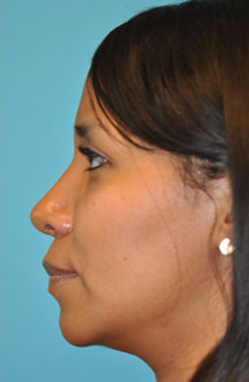 Rhinoplasty (Nose Job) Case 4351 After Photo Rhinoplasty (Nose Job)