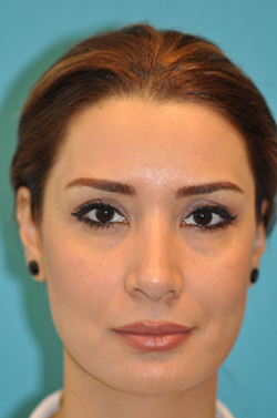 Rhinoplasty (Nose Job) Case 4357 After Photo Rhinoplasty (Nose Job)