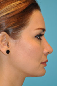 Rhinoplasty (Nose Job) Before and After Photos