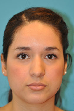 Rhinoplasty (Nose Job) Before and After Photos Case 4363 Before Photo Rhinoplasty (Nose Job) Before and After Photos