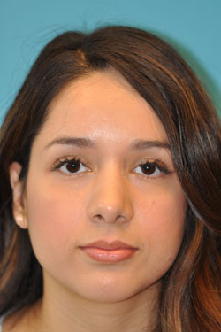 Rhinoplasty (Nose Job) Before and After Photos Case 4363 After Photo Rhinoplasty (Nose Job) Before and After Photos
