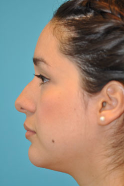 Rhinoplasty (Nose Job) Before and After Photos Case 4363 Before Photo Rhinoplasty (Nose Job) Before and After Photos