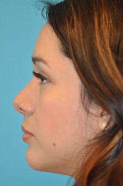 Rhinoplasty (Nose Job) Before and After Photos Case 4363 After Photo Rhinoplasty (Nose Job) Before and After Photos