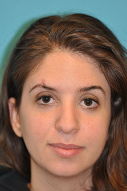 Rhinoplasty (Nose Job) Case 4369 Before Photo Rhinoplasty (Nose Job)