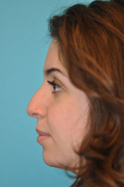 Rhinoplasty (Nose Job) Before and After Photos