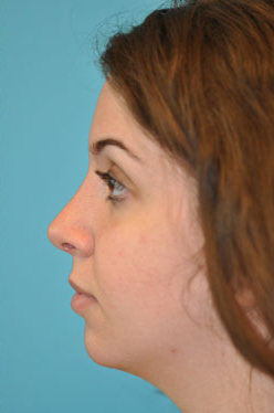 Rhinoplasty (Nose Job) Before and After Photos