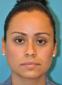 Rhinoplasty (Nose Job) Before and After Photos