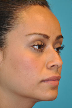 Rhinoplasty (Nose Job) Before and After Photos Case 4375 Before Photo Rhinoplasty (Nose Job) Before and After Photos