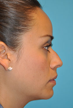 Rhinoplasty (Nose Job) Before and After Photos Case 4375 Before Photo Rhinoplasty (Nose Job) Before and After Photos