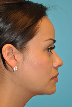 Rhinoplasty (Nose Job) Before and After Photos Case 4375 After Photo Rhinoplasty (Nose Job) Before and After Photos