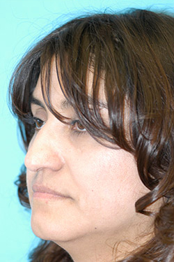 Rhinoplasty (Nose Job) Before and After Photos Case 4383 Before Photo Rhinoplasty (Nose Job) Before and After Photos