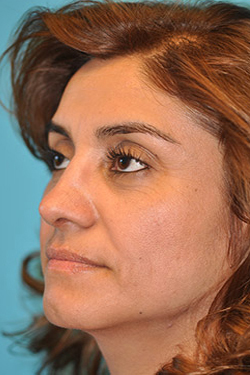 Rhinoplasty (Nose Job) Before and After Photos Case 4383 After Photo Rhinoplasty (Nose Job) Before and After Photos
