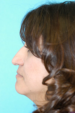 Rhinoplasty (Nose Job) Before and After Photos Case 4383 Before Photo Rhinoplasty (Nose Job) Before and After Photos