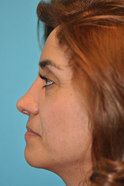 Rhinoplasty (Nose Job) Before and After Photos