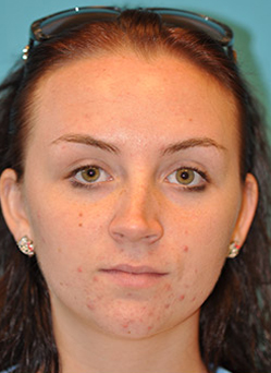 Rhinoplasty (Nose Job) Case 4391 Before Photo Rhinoplasty (Nose Job)