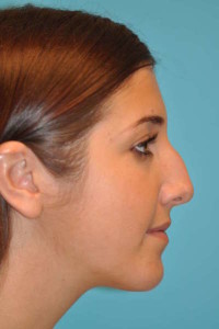 Rhinoplasty (Nose Job) Before and After Photos