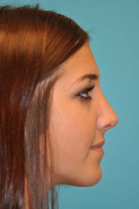 Rhinoplasty (Nose Job) Before and After Photos