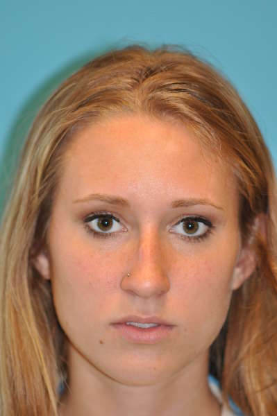 Rhinoplasty (Nose Job) Before and After Photos Case 4403 Before Photo Rhinoplasty (Nose Job) Before and After Photos