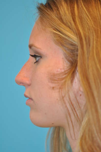 Rhinoplasty (Nose Job) Before and After Photos Case 4403 Before Photo Rhinoplasty (Nose Job) Before and After Photos