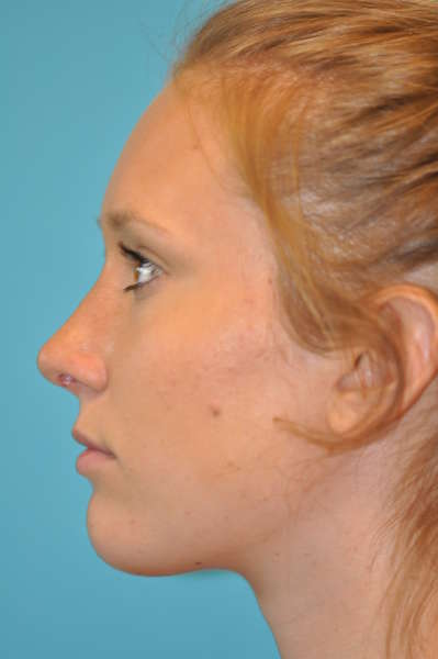 Rhinoplasty (Nose Job) Before and After Photos Case 4403 After Photo Rhinoplasty (Nose Job) Before and After Photos