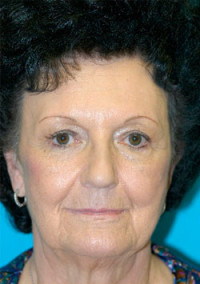 Facelift and Necklift Before and After Photos