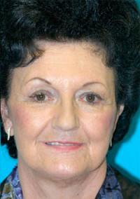 Facelift and Necklift Before and After Photos