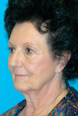 Facelift and Necklift Before and After Photos