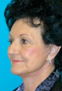 Facelift and Necklift Before and After Photos