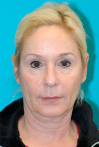 Facelift and Necklift Before and After Photos