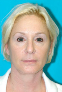 Facelift and Necklift Before and After Photos