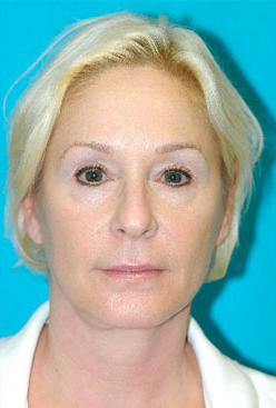 Facelift and Necklift Before and After Photos Case 3471 After Photo Facelift and Necklift Before and After Photos