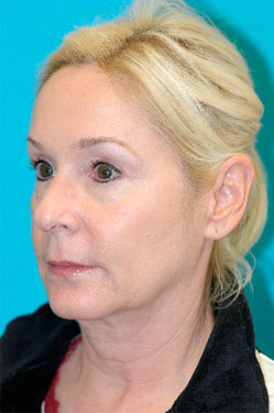 Facelift and Necklift Before and After Photos Case 3471 Before Photo Facelift and Necklift Before and After Photos