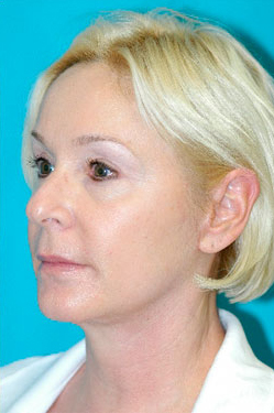 Facelift and Necklift Before and After Photos Case 3471 After Photo Facelift and Necklift Before and After Photos