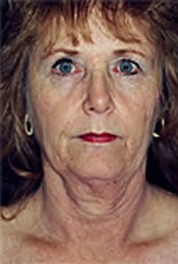 Facelift and Necklift Before and After Photos