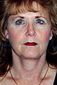 Facelift and Necklift Before and After Photos