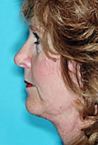 Facelift and Necklift Before and After Photos