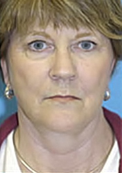 Facelift and Necklift Before and After Photos