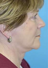 Facelift and Necklift Before and After Photos