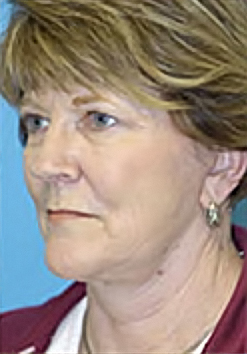 Facelift and Necklift Before and After Photos
