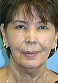 Facelift and Necklift Before and After Photos