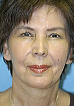 Facelift and Necklift Before and After Photos
