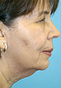 Facelift and Necklift Before and After Photos