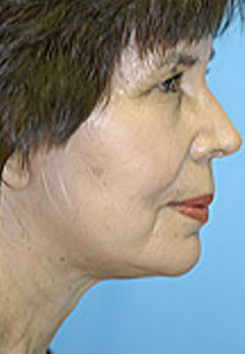 Facelift and Necklift Before and After Photos