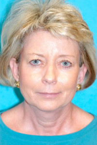 Facelift and Necklift Before and After Photos